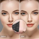 Patch Karboni për Heqjen e Piketave të Hundës - Figura 2