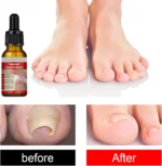 Vaj Për Heqjen e Thonjve të Brendshëm Ingrown Toenail Drops - Figura 3