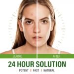 Krem Kundër Akneve & Shenjave të Fytyrës - Figura 3