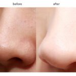 Aparat Ultratingujsh për Pastrimin e Fytyrës - Figura 2